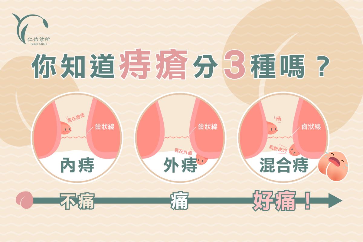 痔瘡 分級,內痔,痔瘡 專業